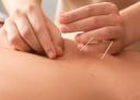 Beauty akupunktura, terapie 120 min.
